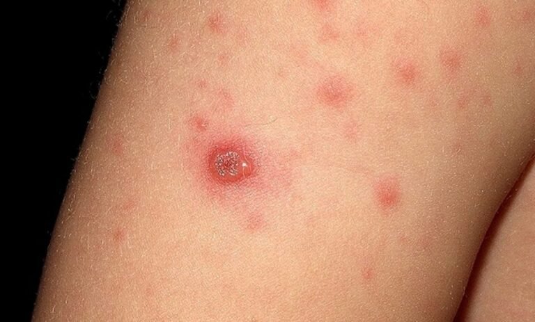 Llaman a completar esquemas de vacunación para prevenir sarampión